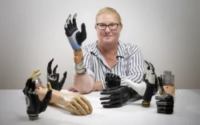 The first woman to receive a neurally controlled bionic hand