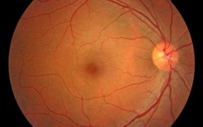 Single-color fundus image AI Tool for diabetic retinopathy screening
