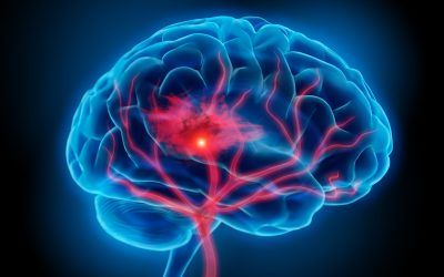 Rethinking stroke monitoring: new criteria urged as EEG activity falls short in assessing brain damage