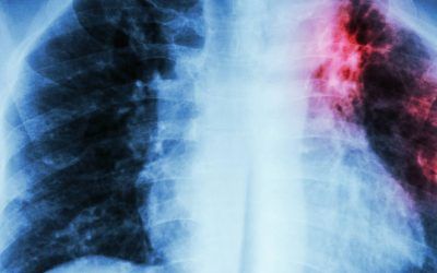 FDA-Authorized an AI biomarker for lung fibrosis diagnostic