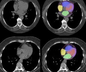 AI predicts cardiac risk an mortality from routine chest CT scansAI