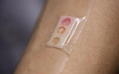 Band-aid-like microlaser device measures glucose levels from sweat