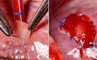 3D cardiac patch for safer heart repair