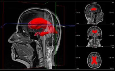 Cuando la forma del cerebro predice el éxito quirúrgico: un nuevo marcador 3D para la hidrocefalia normotensiva