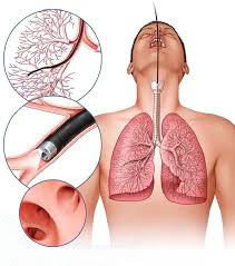 La biopsia pulmonar con frío logra más diagnósticos correctos y menos complicaciones que el fórceps