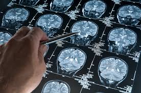 Investigadores españoles reducen un 90% el tiempo de las resonancias cerebrales con IA y datos sintéticos