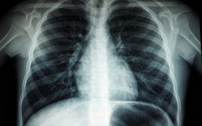Nuevo método de imagen predice mutaciones genéticas en cáncer de pulmón