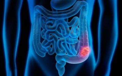 Sistema de IA guía captación proactiva y mejora el cribado de cáncer colorrectal