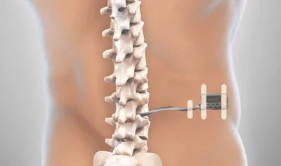Neuroestimulación espinal bloquea el dolor crónico y evita cirugías mayores