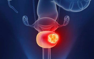 Minar historiales clínicos con IA anticipa el cáncer de vejiga cinco años antes